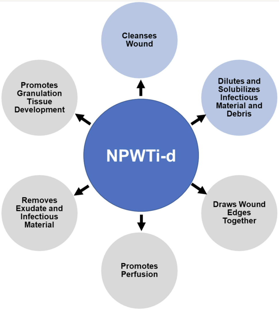 Negative Pressure Wound Therapy With Instillation and Dwell Time